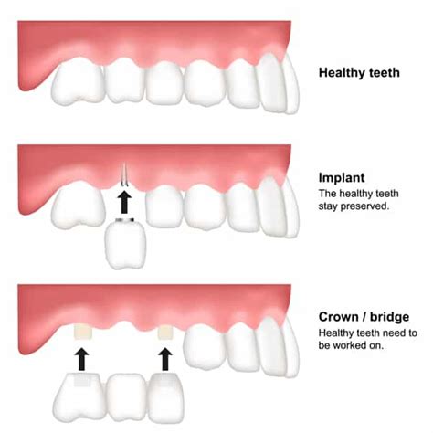 Implants Vs Crowns Bridge Schuman Center Dental Aesthetics