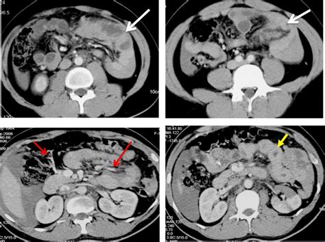 Segmental Renal Infarction And Mesenteric Injury Post Trauma