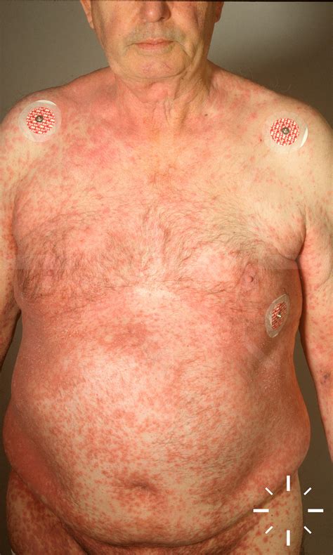 Dermacompass Stevens Johnson Syndrome And Toxic Epidermal Necrolysis
