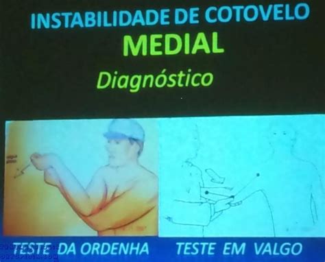 Luxa O De Cotovelo Traumatologia E Ortopedia