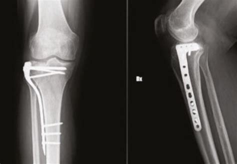 Multifragmentary Lateral Right Tibial Plateau Fracture