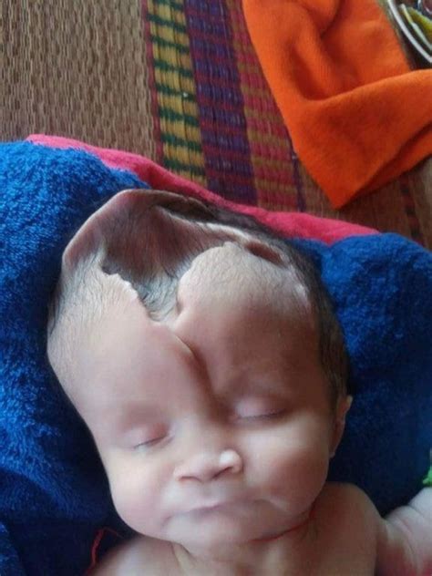 Photos Baby Born With Part Of Her Skull Jutting Out Of