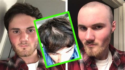 Balding In College Going Bald As A College Student Youtube