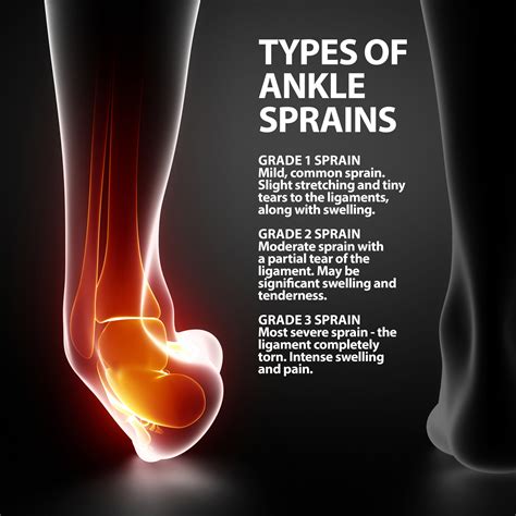 Sprained Ankle Florida Orthopaedic Institute