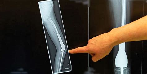 Limb Salvage Surgery Way To Heal