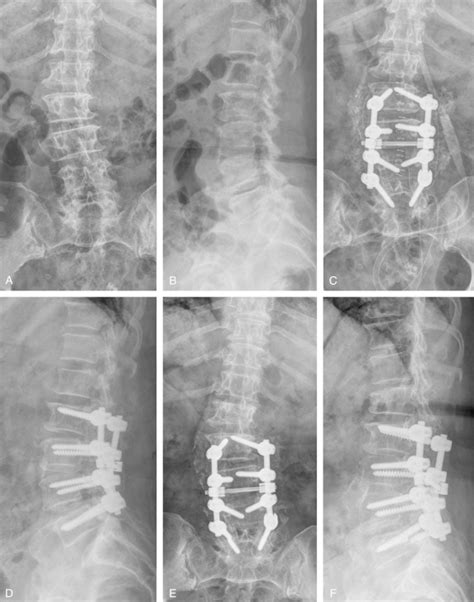 A B A 68 Year Old Female Has Degenerative Lumbar Scoliosis With A