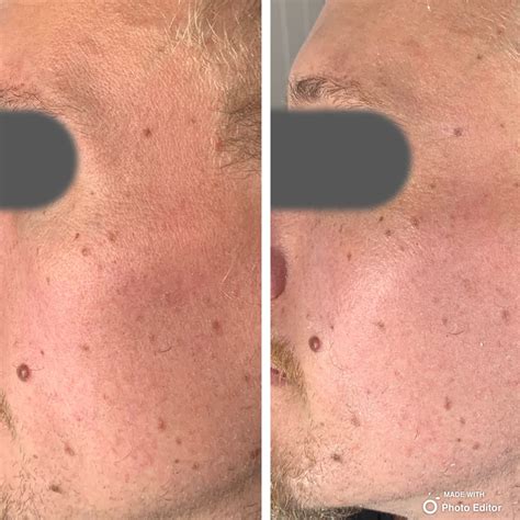 Bespoke Chemical Peels In Reading Crysallis Skin Clinic