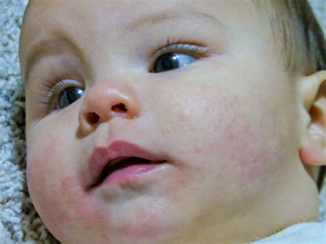 Baby Eczema Colin Had Some Eczema Popping Up On His Face Flickr