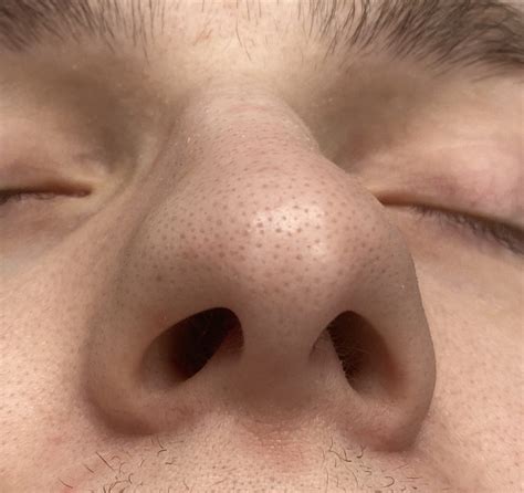 Plastic Surgery Case Study Narrowing The Wide Male Nasal Tip Tip