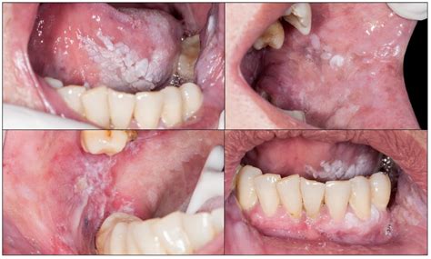 Cancers Free Full Text Challenges In The Early Diagnosis Of Oral