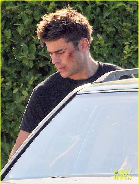 Zac Efron Sports Facial Injuries For We Are Your Friends Filming