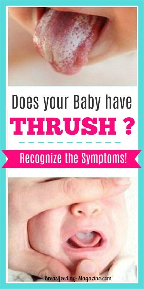 Recognizing Thrush Symptoms When Breastfeeding And Treatment Options