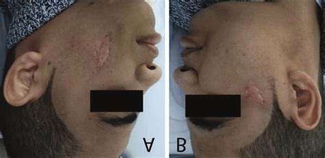 A Complete Healing Of The Skin Ulcer In The Right Cheek With Scar