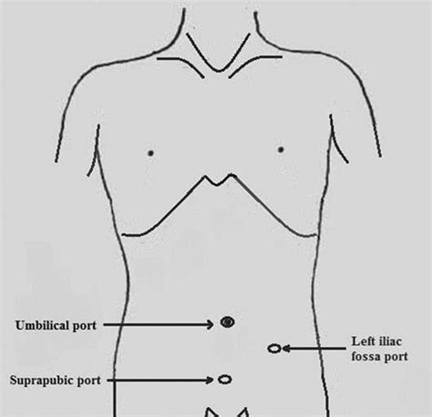 Port Position In Laparoscopic Appendectomy Download Scientific Diagram