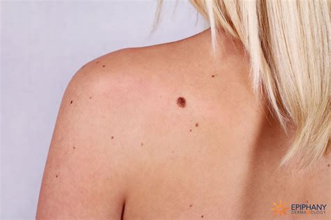 How To Tell The Difference Between Skin Tags Moles And Warts