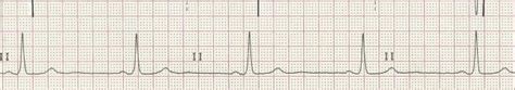 画像をダウンロード Sinus Bradycardia Rhythm 6 Second Strip 231918