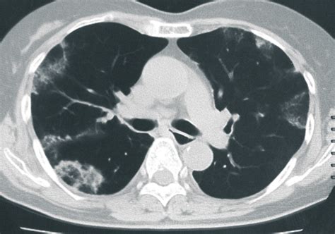 Ct Scan On Admission Showed Patchy Consolidation In Bilateral Upper