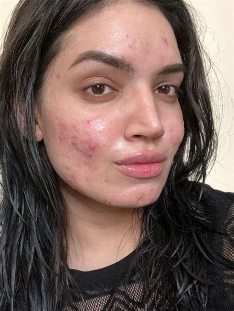 Kadeeja Khan In 2022 Girl With Acne Bare Beauty Acne Skin