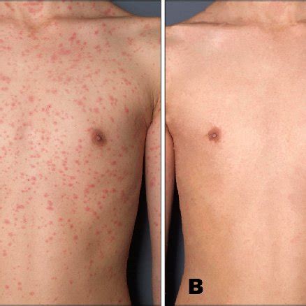 Clinical Features Of Pityriasis Rosea Before A And After B UVA1