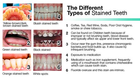 How To Remove Brown Stains From Teeth Unugtp News