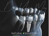 Zirconium Dental Implants Side Effects