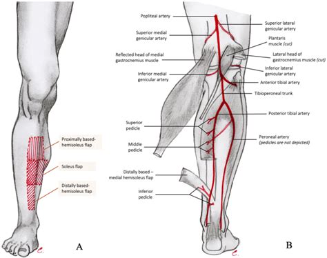 Schematic Image Shows Area Coverage By Different Types Of Soleus Muscle