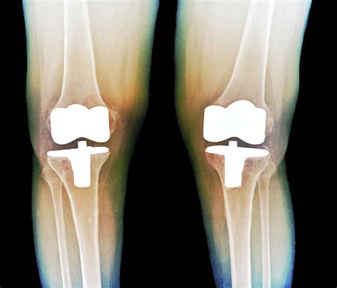 Bilateral Total Knee Replacement Photograph By Zephyrscience Photo Library Pixels