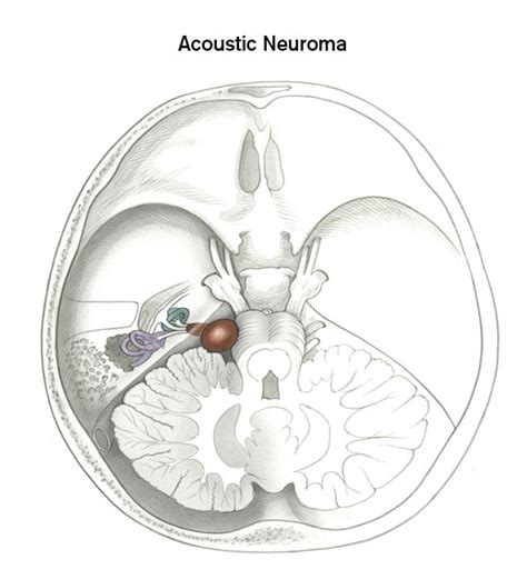 Acoustic Neuroma And Skull Base Tumors Brigham And Womens Faulkner