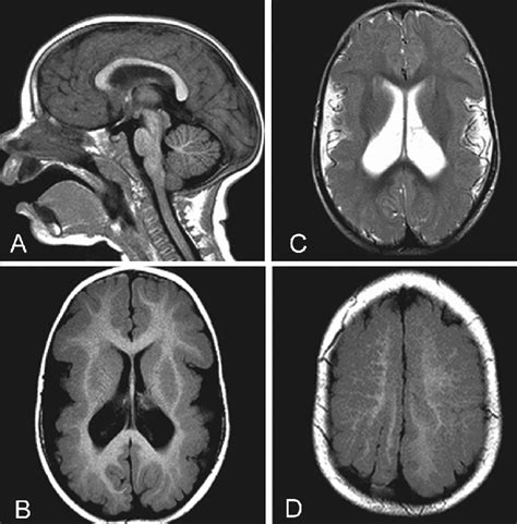 Brain Magnetic Resonance Imaging Findings A T1 Weighted Sagittal Image Download Scientific