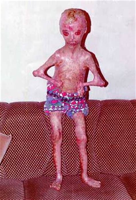 Health effects of uranium typically are not related to the element's radioactivity, since the alpha particles emitted by uranium cannot even penetrate the skin. Radiation contamination by Depleted Uranium