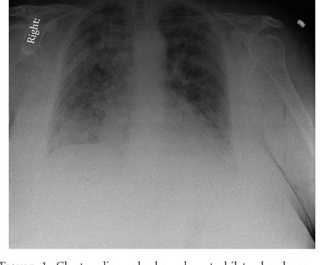 Figure 1 From Acute Interstitial Pneumonia Hamman Rich Syndrome As A Cause Of Idiopathic Acute