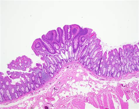 Case Of The Month Numerous Colonic Polyps University Of Rochester