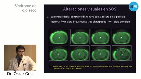 síndrome del ojo seco la patología oftalmológica más frecuente dr Óscar gris youtube