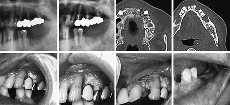 Osteonecrosis Of Jaw Onj Images And Oral Cavity Findings A C Simple