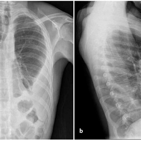 Chest X Ray Showing A Small Unilateral Pleural Effusion And A Discrete