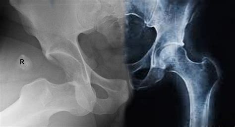 Anterior Vs Posterior Hip Dislocation