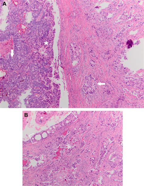 Salivary Duct Carcinoma Ex Pleomorphic Adenoma Of The Palate A Case