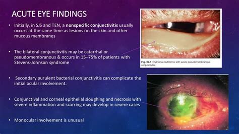 Ocular Cicatricial Pemphigoid Stevens Johnson Syndrome Toxic Epider