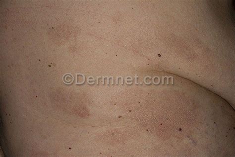 T Cell Lymphoma Ctcl Cutaneous T Cell Lymphoma Photo Skin Disease