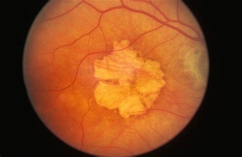 Macular Atrophy Retina Image Bank