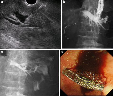 Eus Guided Hepaticogastrostomy Hgs A An Intrahepatic Bile Duct Was