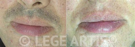 Laser Hair Removal Toronto Lege Artis