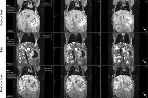 Comparison Of Mri Imaging Of Bl0293 F563 Liver Metastases Mri Images