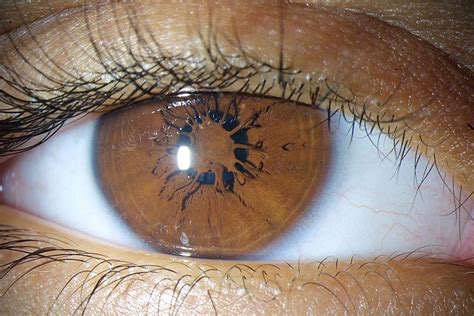 Persistent Pupillary Membrane Ppm Is A Condition Of The Eye Involving