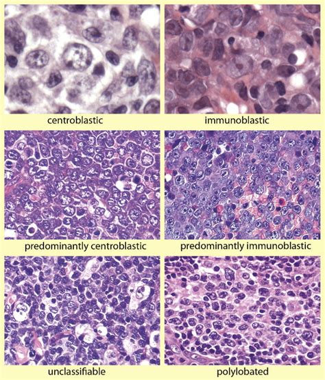 Diffuse Large B Cell Lymphoma Diagnostic Histopathology
