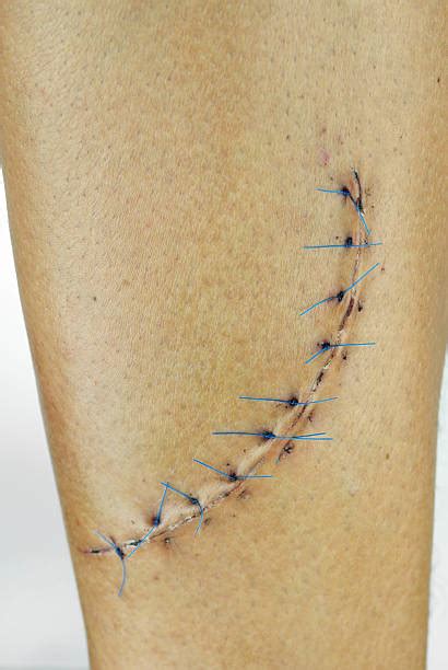 Medical Stitches Pictures Images And Stock Photos Istock