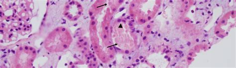 Acute Tubular Necrosis American Society Of Pediatric Nephrology Aspn