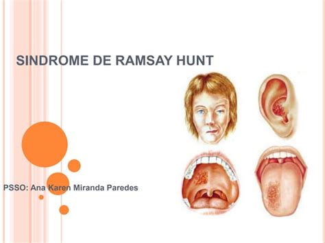 Síndrome De Ramsay Hunt Causas Síntomas Y Tratamiento Ppt