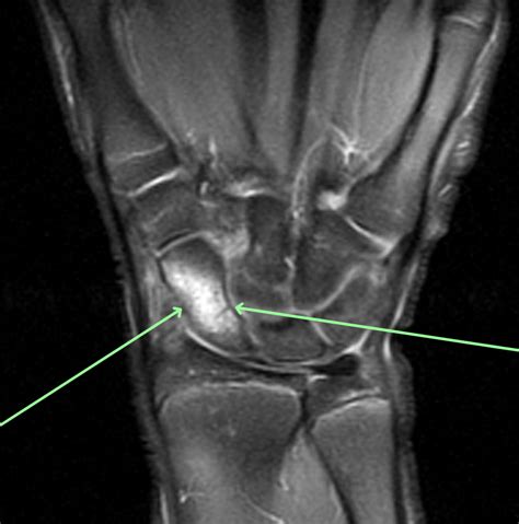 scaphoid fracture diagnosis mri online