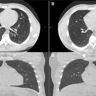 Axial And Coronal Ultra Low Dose Ct Thorax Pretreatment A And Post